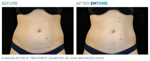 Emtone PIC Ba-card-female-abdomen-008 ENUS100