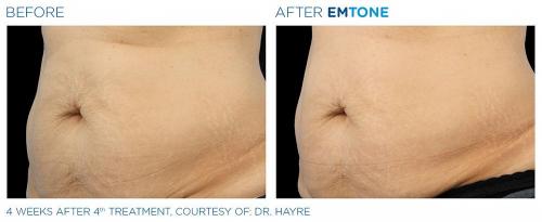 Emtone PIC Ba-card-female-abdomen-011 ENUS100