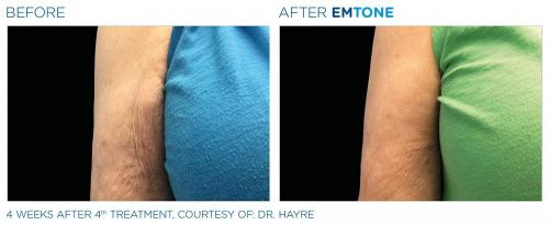 Emtone PIC Ba-card-female-arms-013 ENUS100