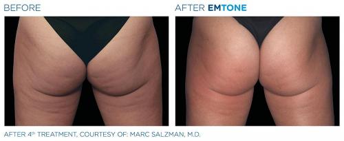 Emtone PIC Ba-card-female-buttock-001 ENUS100