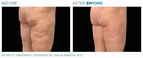 Emtone PIC Ba-card-female-buttock-010 ENUS100