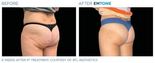 Emtone PIC Ba-card-female-buttock-014 EN100