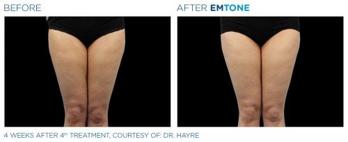 Emtone PIC Ba-card-female-thighs-012 EN100