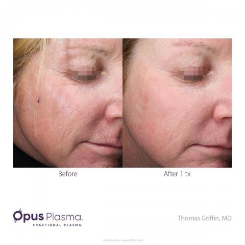 Opus-Before-and-After-B2C-11 res