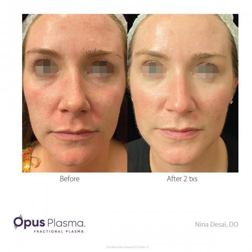 Opus-Before-and-After-B2C-1 res