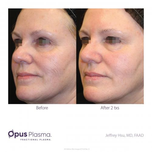 Opus-Before-and-After-B2C-4 res