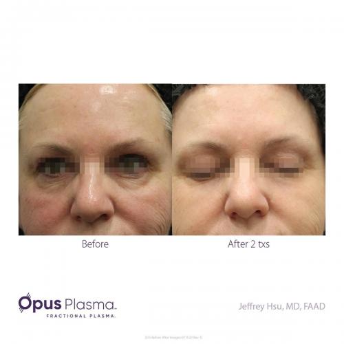 Opus-Before-and-After-B2C-5 res