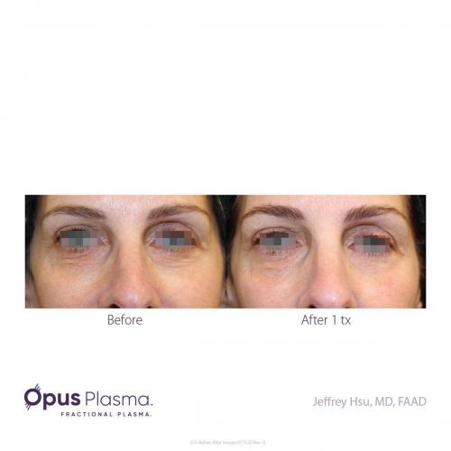 Opus-Before-and-After-B2C-6 res