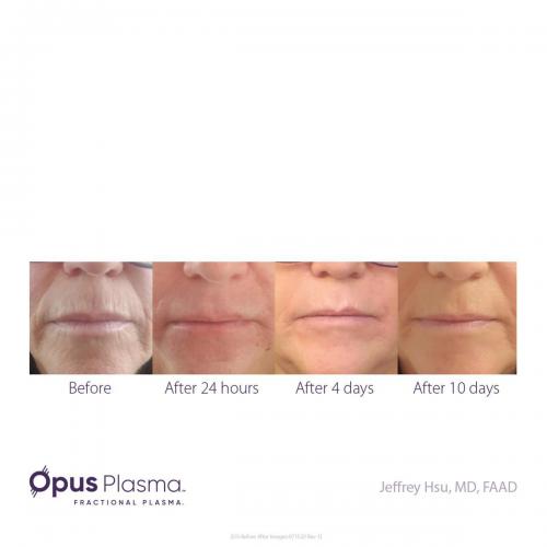 Opus-Before-and-After-B2C-8 res